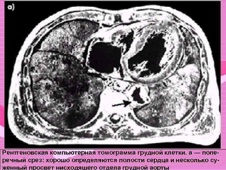 Рентгеновская компьютерная томограмма грудной клетки. а — поперечный срез: хорошо определяются полости сердца и