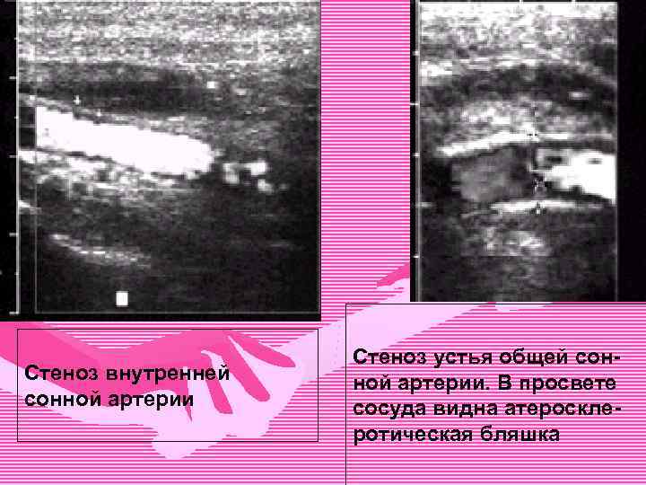 Стеноз внутренней сонной артерии Стеноз устья общей сонной артерии. В просвете сосуда видна атеросклеротическая