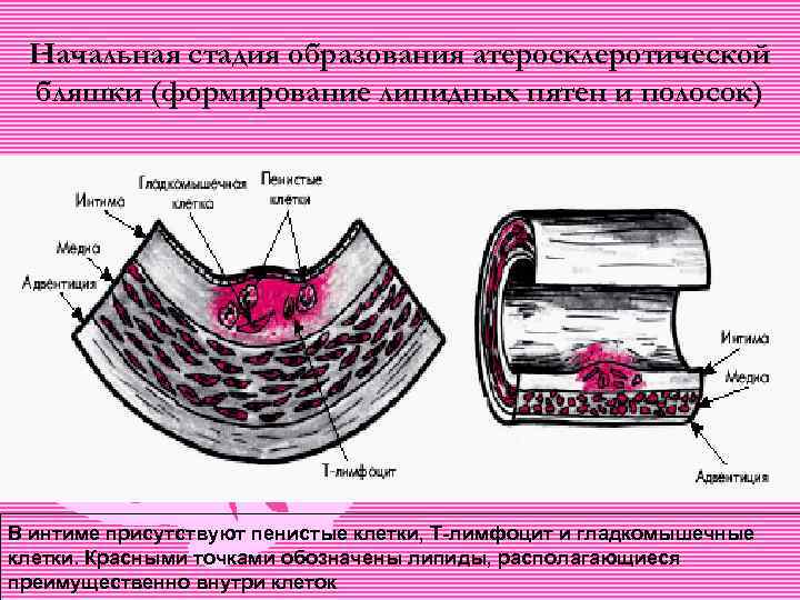 Начальная стадия образования атеросклеротической бляшки (формирование липидных пятен и полосок) В интиме присутствуют пенистые