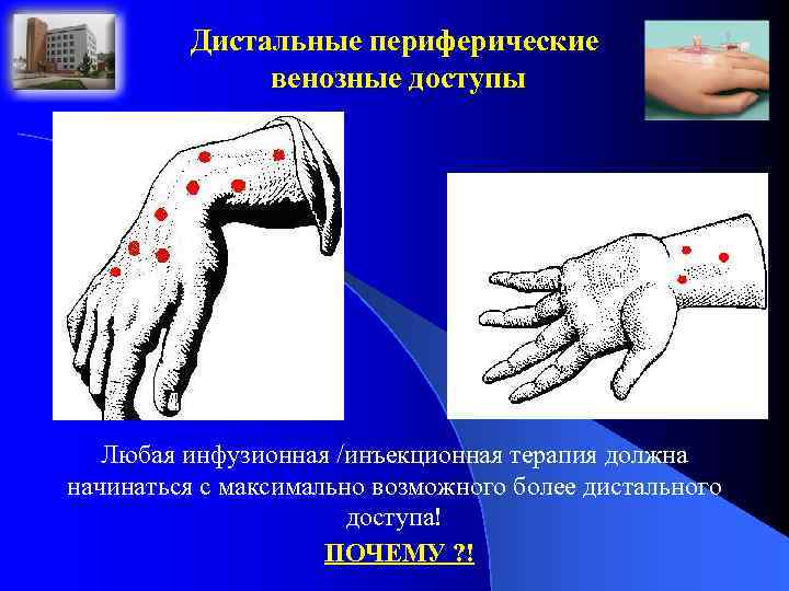 Дистальные периферические венозные доступы Любая инфузионная /инъекционная терапия должна начинаться с максимально возможного более