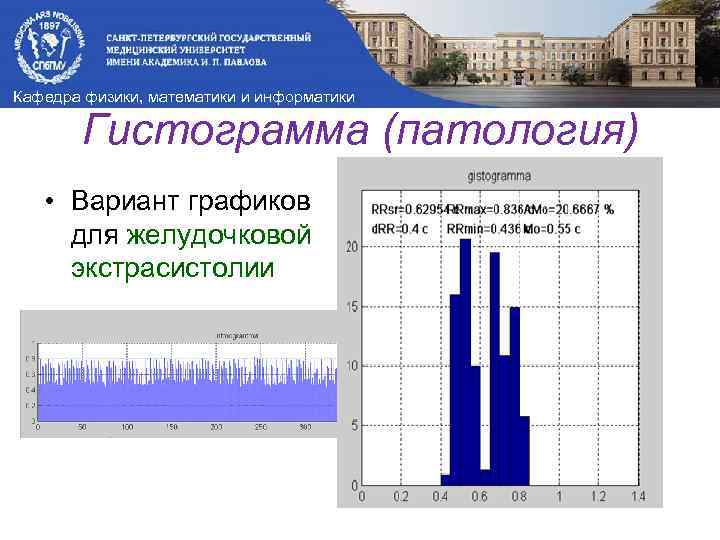 Кафедра физики, математики и информатики Гистограмма (патология) • Вариант графиков для желудочковой экстрасистолии 