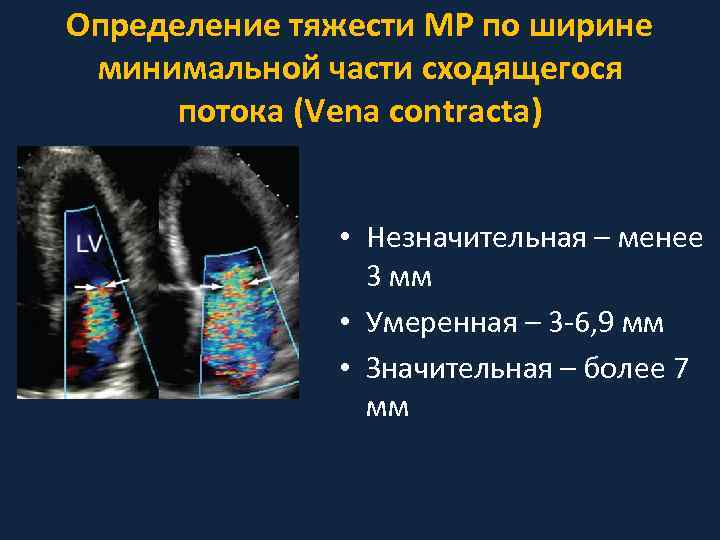 Определение тяжести МР по ширине минимальной части сходящегося потока (Vena contracta) • Незначительная –