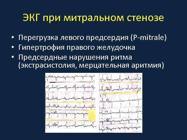 ЭКГ при митральном стенозе • Перегрузка левого предсердия (P-mitrale) • Гипертрофия правого желудочка •