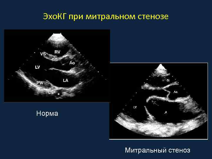 Фото митральный стеноз