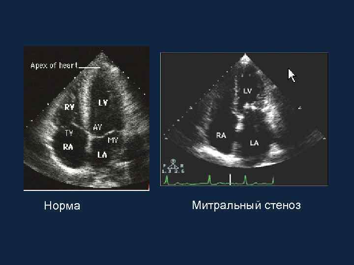 Норма Митральный стеноз 