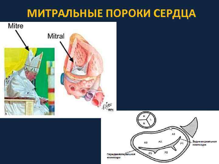 Клиническая картина пороков сердца