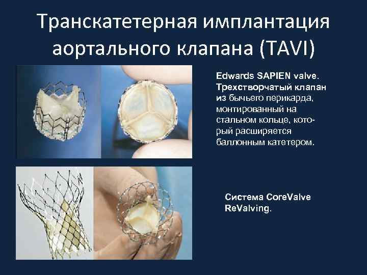 Транскатетерная имплантация аортального клапана (TAVI) Edwards SAPIEN valve. Трехстворчатый клапан из бычьего перикарда, монтированный