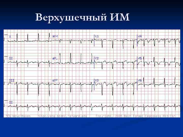 Верхушечный ИМ 