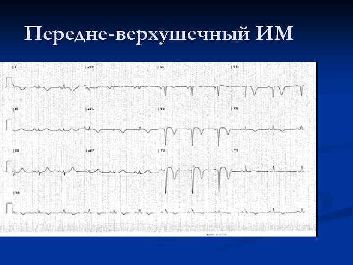 Инфаркт миокарда передне перегородочной