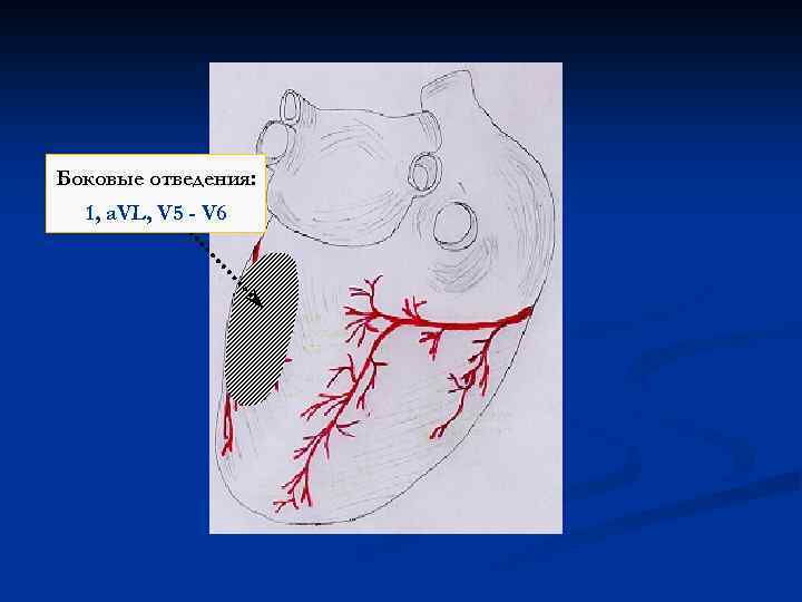Боковые отведения: 1, a. VL, V 5 - V 6 