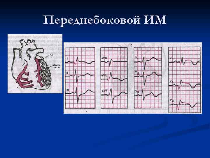 Переднебоковая стенка на экг