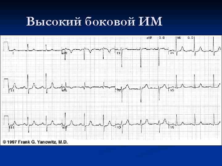 Высокий боковой ИМ 