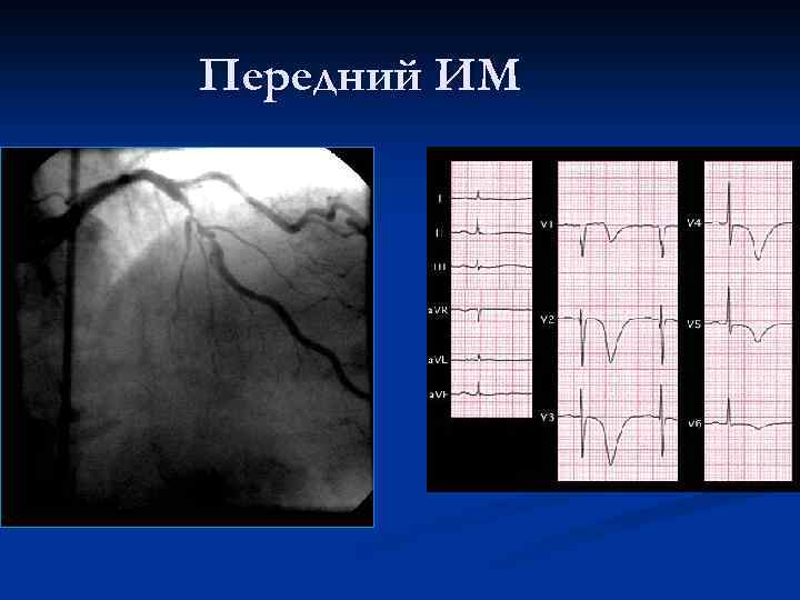 Передний ИМ 