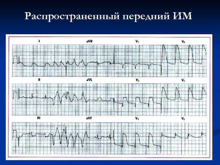 Распространенный передний ИМ 