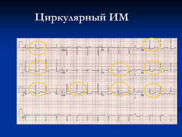 Реполяризационные изменения нижней стенки