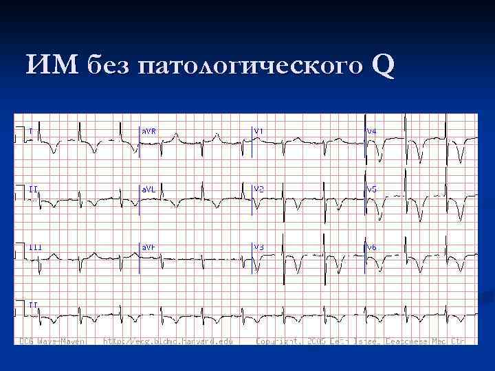 Патологический зубец q при инфаркте