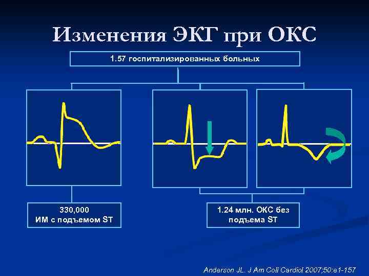 Изменения ЭКГ при ОКС 1. 57 госпитализированных больных 330, 000 ИМ с подъемом ST
