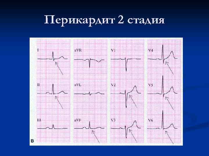 Перикардит 2 стадия 