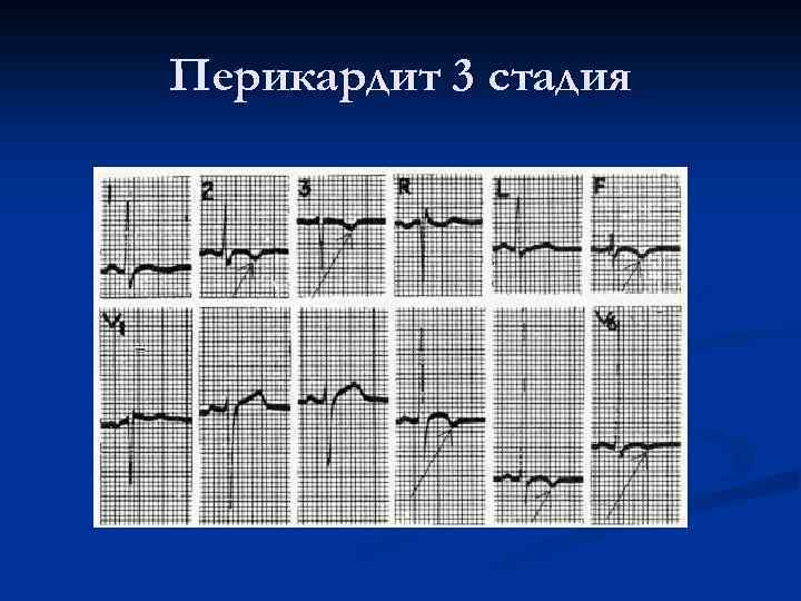Перикардит 3 стадия 