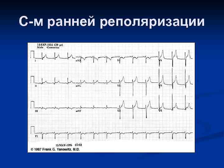 Метаболические изменения на экг