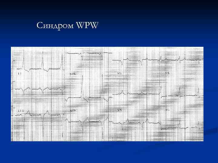 Синдром WPW 