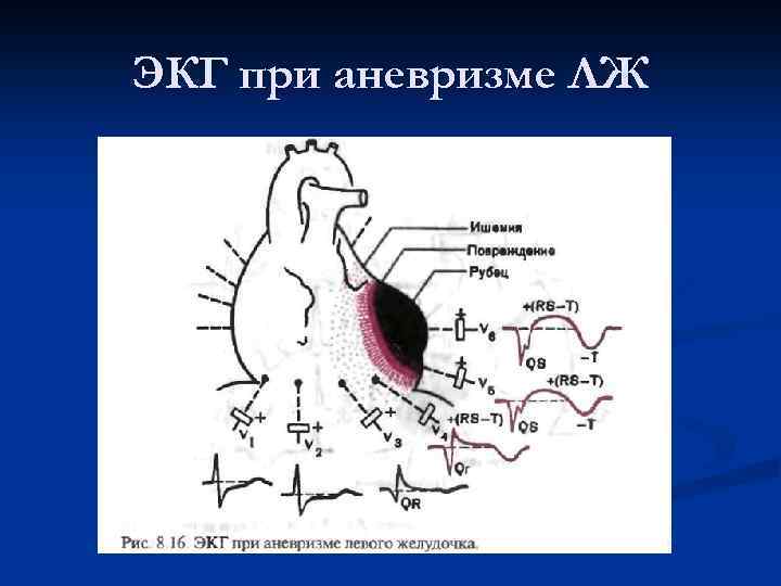 ЭКГ при аневризме ЛЖ 