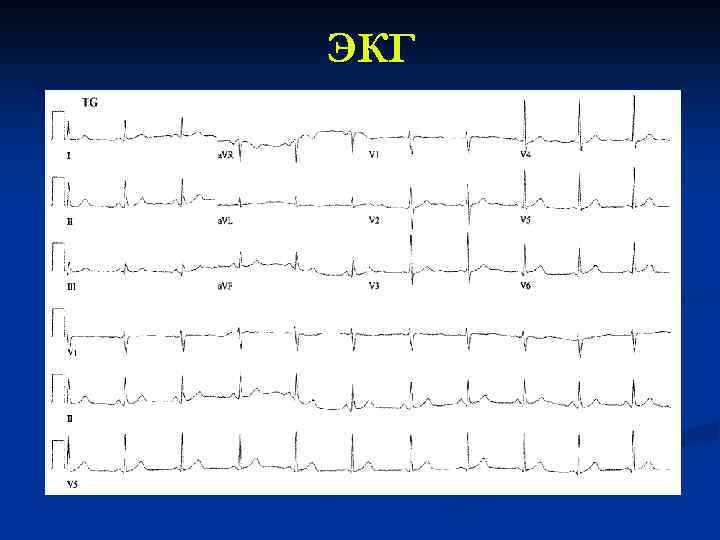 ЭКГ 