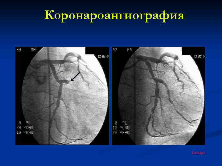 Коронароангиография Dadkhah 