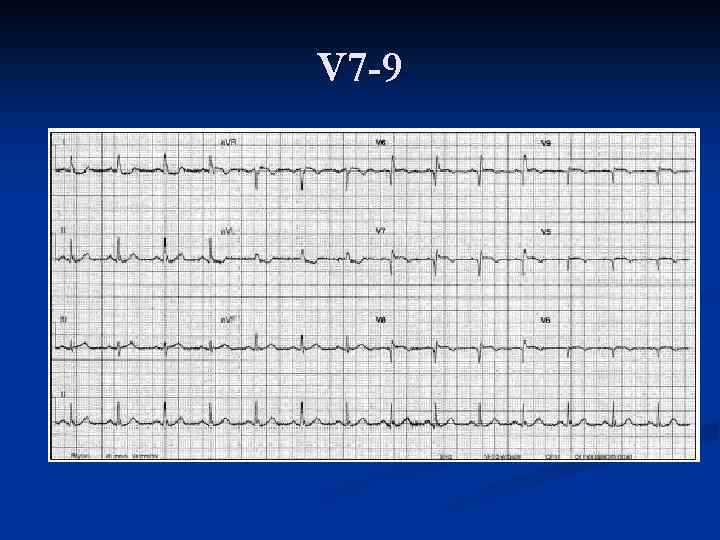 Очаговые изменения на экг. Кардионевроз на ЭКГ. Изменения на ЭКГ при кардионеврозе. Сердце ЭКГ И кардионевроз. Нейрогормональные изменения на ЭКГ сердца.