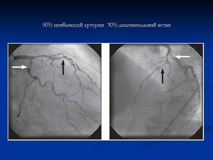 90% огибающей артерии 70% диагнональной ветви 