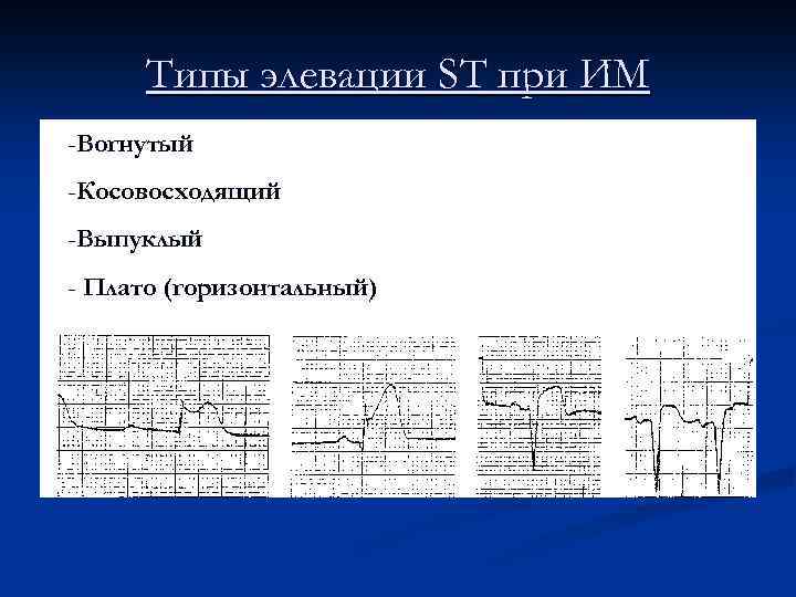 Типы элевации ST при ИМ -Вогнутый -Косовосходящий -Выпуклый - Плато (горизонтальный) 