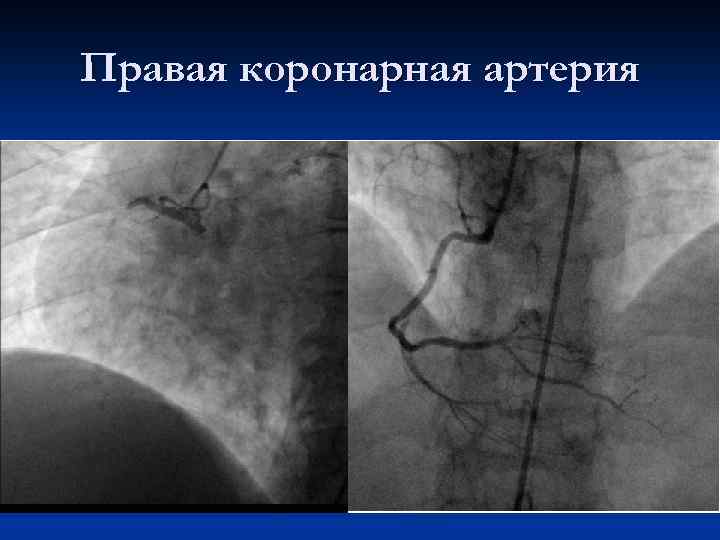 Правая коронарная артерия 