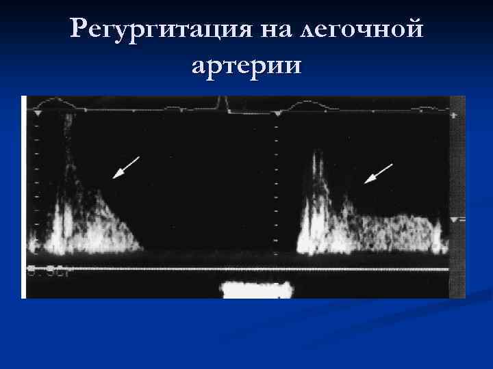 Регургитация на легочной артерии 