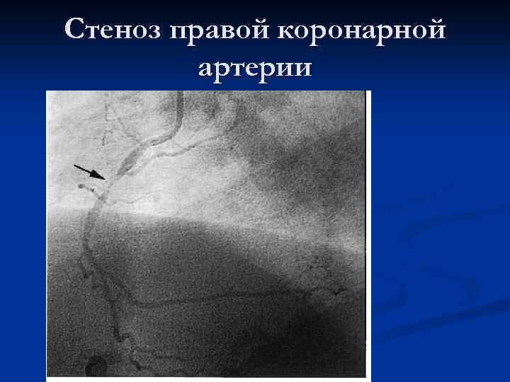 Стеноз правой коронарной артерии 