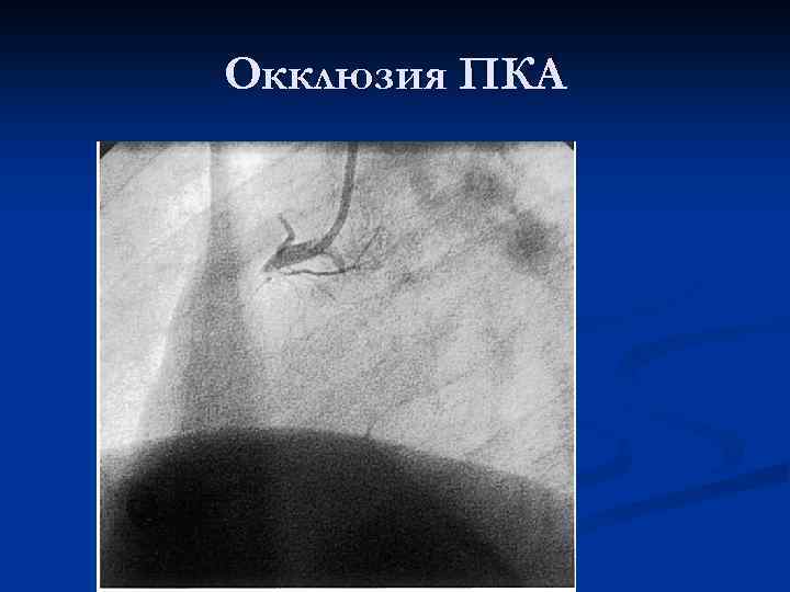 Окклюзия ПКА 