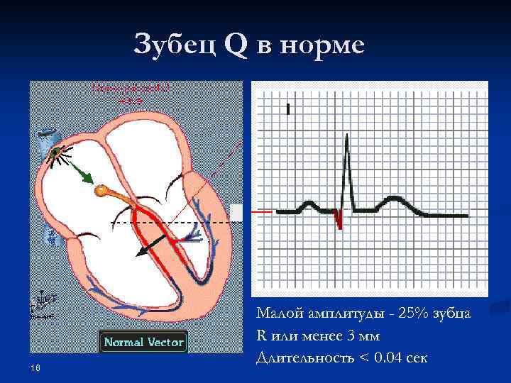 Зубец Q в норме 16 Малой амплитуды - 25% зубца R или менее 3