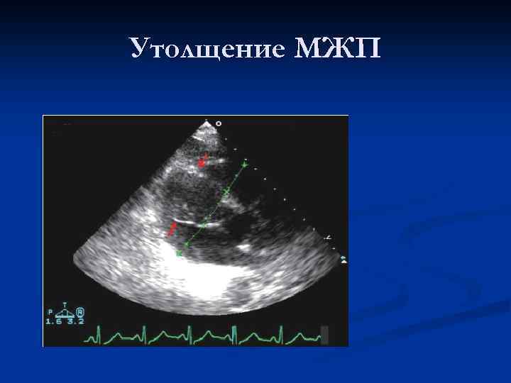 Утолщение МЖП 