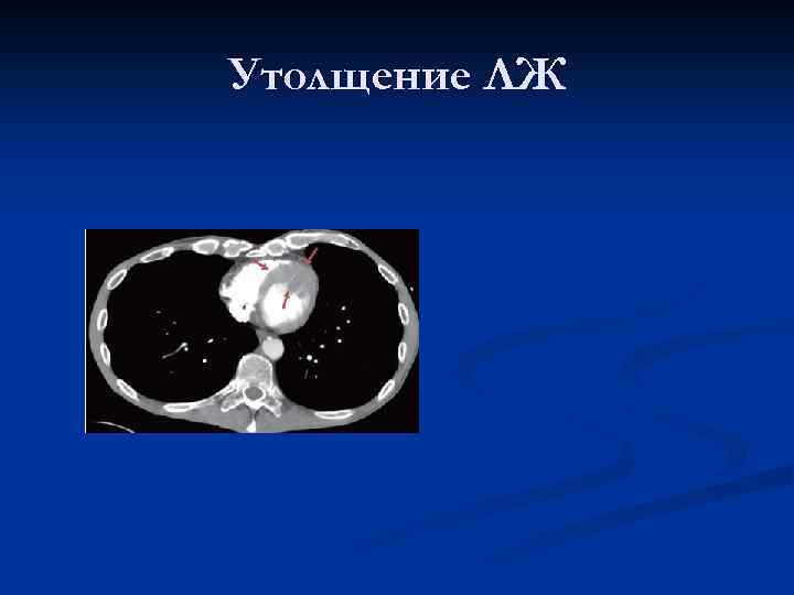 Утолщение ЛЖ 