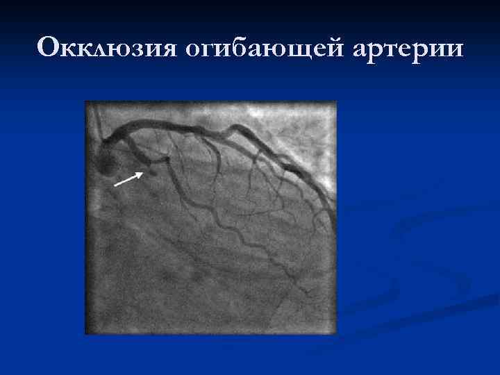 Окклюзия огибающей артерии 