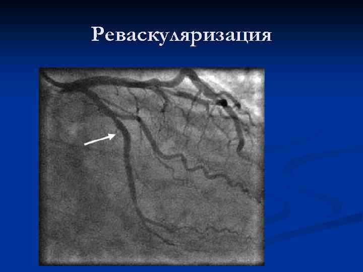 Реваскуляризация 