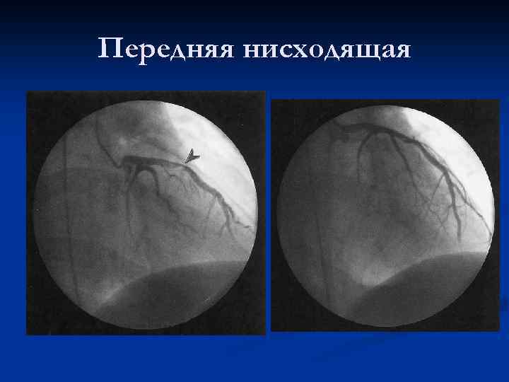 Передняя нисходящая 