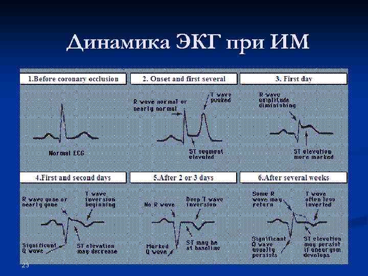 Динамика ЭКГ при ИМ 23 
