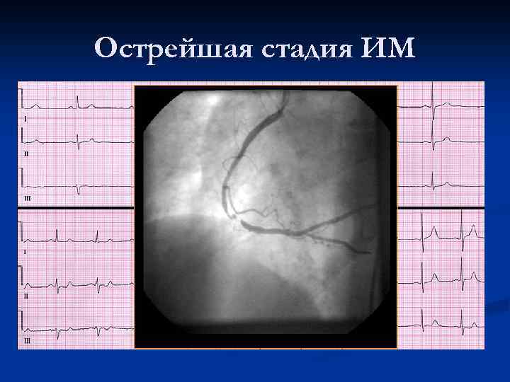 Острейшая стадия ИМ 