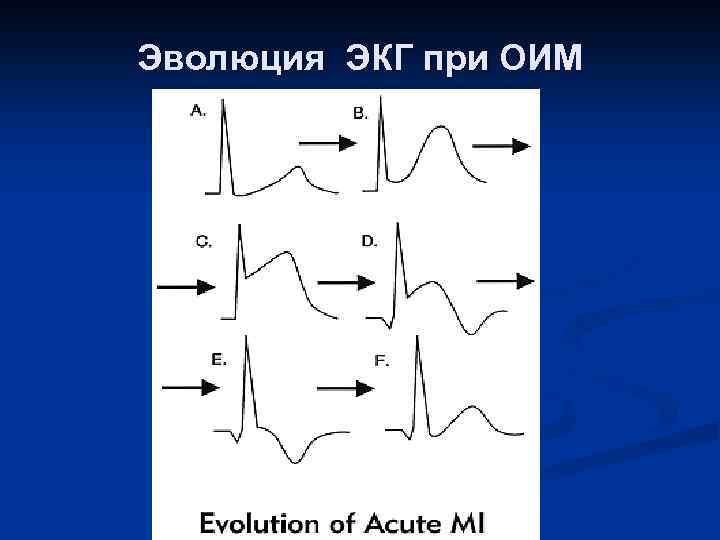 Эволюция ЭКГ при ОИМ 