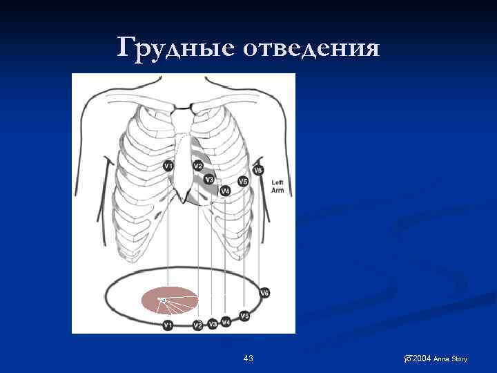 Грудные отведения 43 2004 Anna Story 