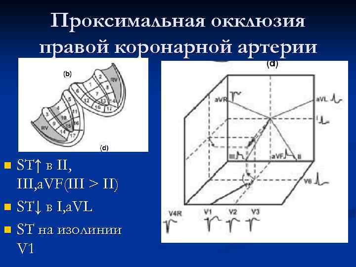 Проксимальная окклюзия правой коронарной артерии ST↑ в II, III, a. VF(III > II) n