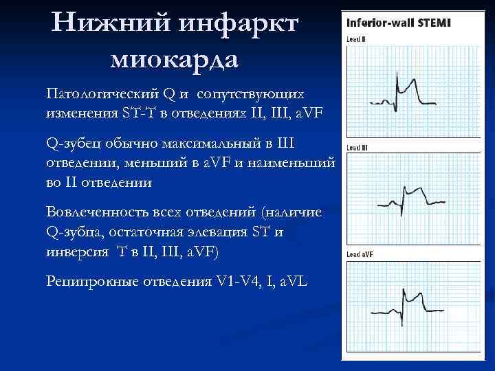 V1 v2 на экг