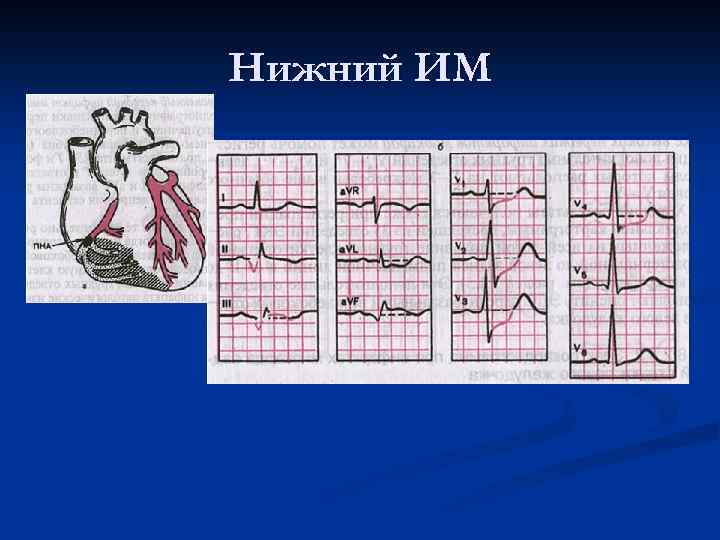 Нижний ИМ 