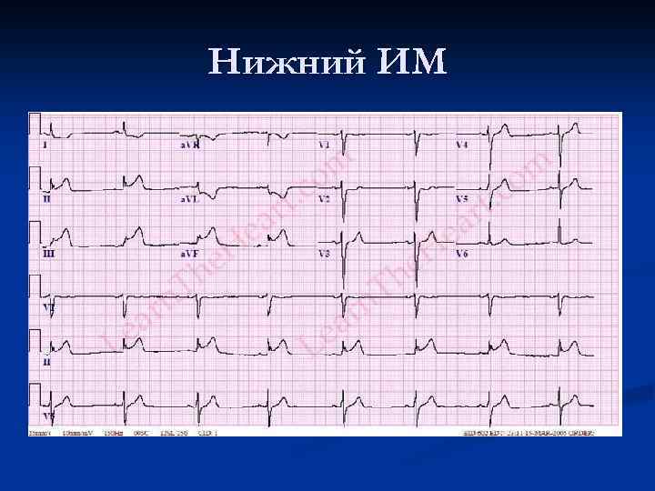 Нижний ИМ 