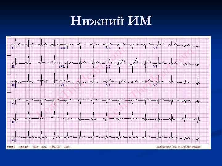 Нижний ИМ 